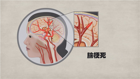 腦梗死_缺血性卒中_神經(jīng)內(nèi)科