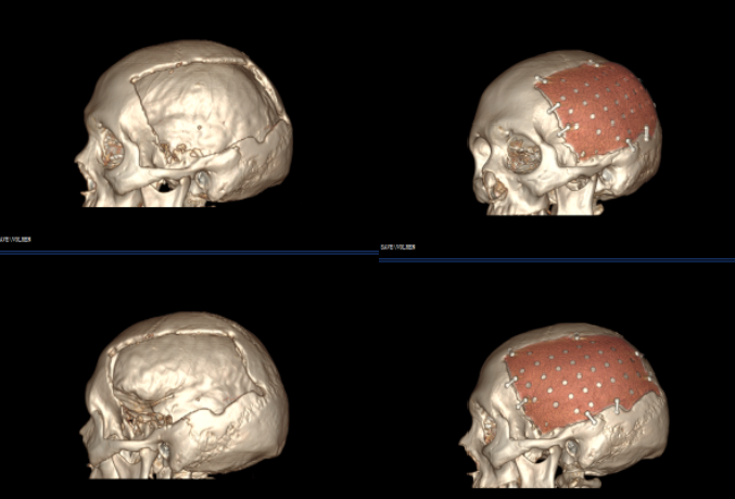 巨型顱骨缺損丨華安精湛醫(yī)術(shù)，重塑頭顱